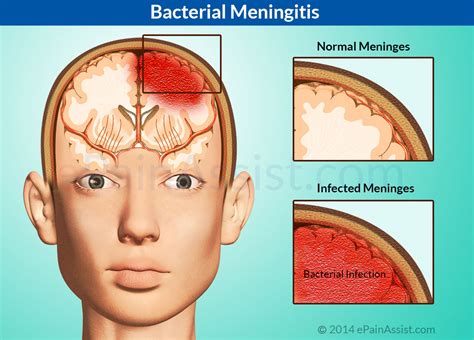 Bacterial Meningitiscausesrisk Factorssymptomsdiagnosistreatment