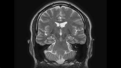 Stand Up Mri Brain Scan