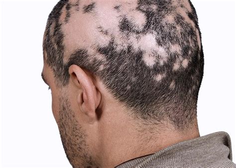 Alopecia Cicatricial Clínica Ideal Dermatologia Capilar