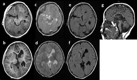 A Case Of Tubulinopathy Presenting With Porencephaly Caused By A Novel