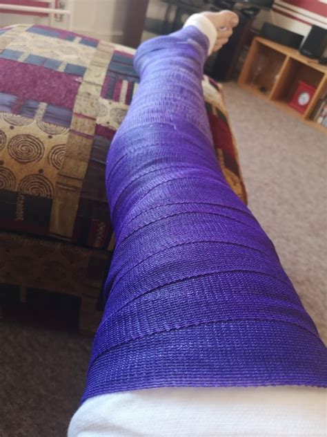 leg cast on Tumblr