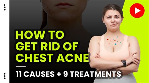 How To Get Rid Of Chest Acne 11 Causes 9 Treatments Youtube