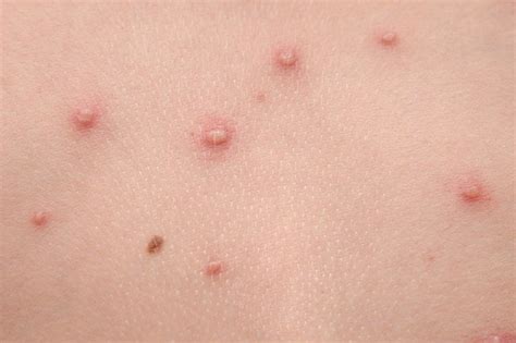 Pimple Rash On Toddler Skin Rashes Childhood Infections Rash Baby