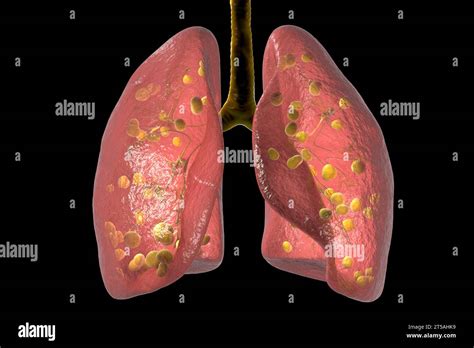 Lung Histoplasmosis A Fungal Infection Caused By Histoplasma