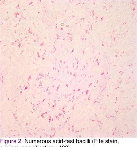 Figure 2 From Disseminated Cutaneous Mycobacterium Haemophilum