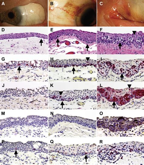 Immunohistochemical Profiling Of Conjunctival Melanocytic