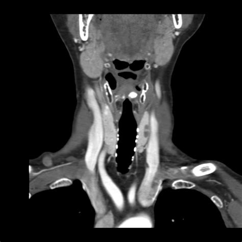 Parathyroid Adenoma Image