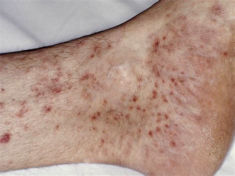 Hon a/prof amanda oakley, dermatologist, hamilton, new zealand, 2010. Primair HIV exantheem