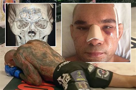 Cyborg Santos Post Surgery Skull Mirror Online