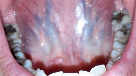 Purple Tongue Causes Including Spots Under Tongue Veins And Bumps