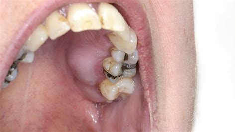 Causes And Treatment Of Plaque On Teeth