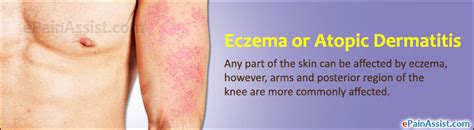 Eczema Or Atopic Dermatitiscausessymptomstreatmenthome Remedies