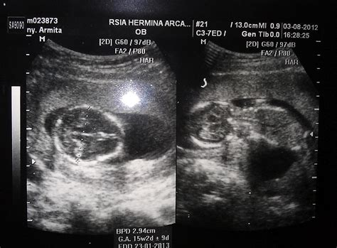 Gambar Usg Bayi 5 Bulan Dalam Kandungan Adzka