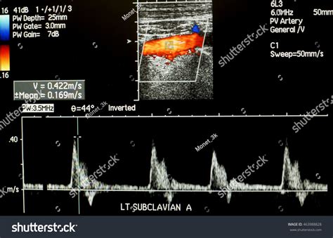 Doppler Ultrasound Left Subclavian Artery Wave Shutterstock