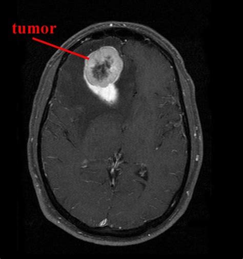 Tumor Left Frontal Lobe Tumor