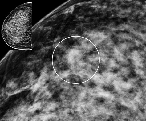 Digital Mammography Versus Digital Mammography Plus Tomosynthesis In