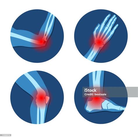 Reuma Of Reumatische Aandoening Medische Ingesteld Artritis