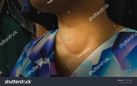 Anterior Next Swelling Thyroid Goitre写真素材1273310203 Shutterstock