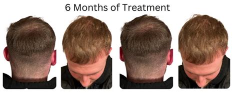 Eds Hair Loss Treatment Journey 6 Month Update
