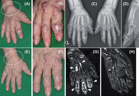 Successful Treatment Of Multicentric Reticulohistiocytosis With