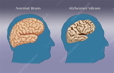 Alzheimers And Normal Brains Comparison Stock Image F0318271