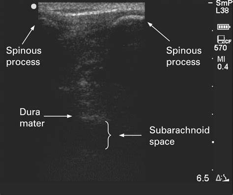 Ultrasound Identification Of Landmarks Preceding Lumbar Puncture A