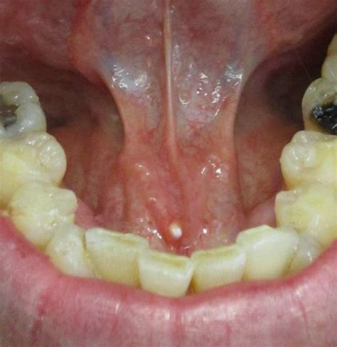 Gross Mouth Diseases