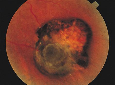 Acquired Tumors Arising From Congenital Hypertrophy Of The Retinal