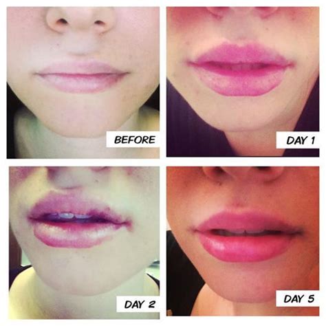 Beautiful Result For A Lip Enhancement Day One Slight Swelling Day