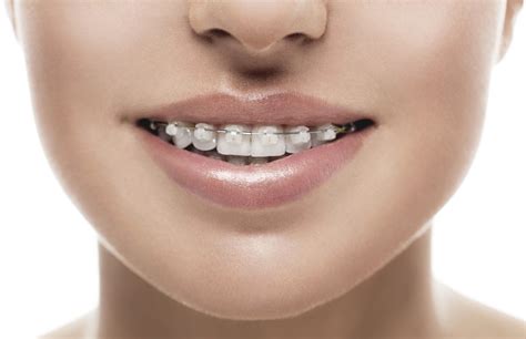 Affordable Braces Near Me Indy Orthodontist Orthodontics