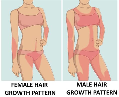 Everything You Need To Know About Excessive Hair In Women