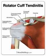 Pictures of Tendonitis Therapy