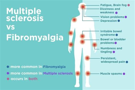 Fibromialgia Vs Esclerose Múltipla Em Diferenças Em Sinais E Sintomas Hot Press Releases