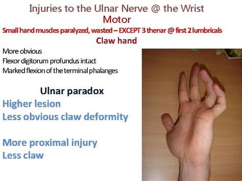 Ulnar Nerve Anatomy Innervation Injury Damage Palsy Entrapment In 2021