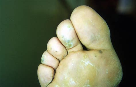 Viral Infections Plantar Warts Picture Hellenic Dermatological