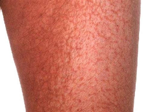 Ichthyosis Pictures Symptoms Causes And Treatment 2018 Updated