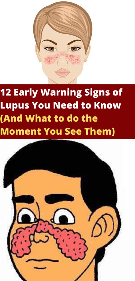12 Early Warning Signs Of Lupus You Need To Know And What To Do The