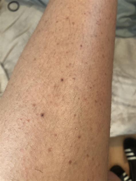Skin Concerns I Have Horrible Ingrowns On My Thighs That Are Dark And