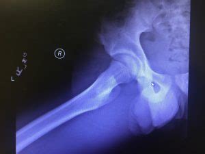 Conservative treatment (nof stress fracture). Avulsion of the lesser Trochanter - Charter Radiology