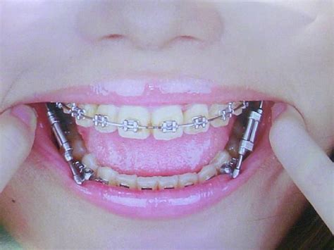 Pin By Shrood Burgos On Braces Perfect Teeth Braces Girls Beautiful