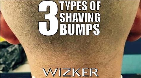 The 3 Types Of Shavinghair Removal Bumps Bump Hairstyles Razor