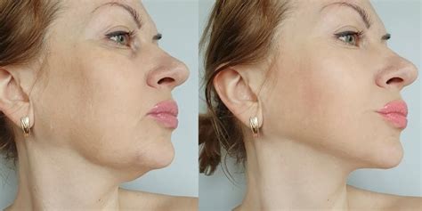 Chin Thread Lift 6 Best Benefits And Risk And Before And After