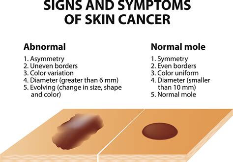 Skin Cancer Illinois Dermatology Institute