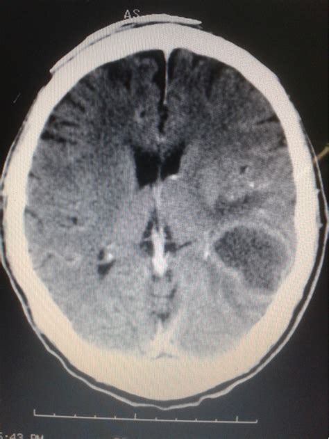 Computed Tomography Ct Brain Scan Showed Cystic Enhancing Lesion