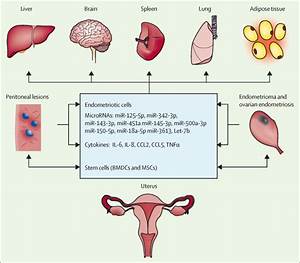 Endometriosis Is A Chronic Systemic Disease Clinical Challenges And