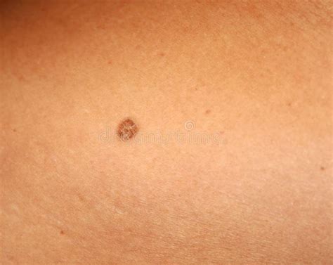 Brown Spots On Skin Cancer