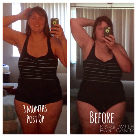 Gastric sleeve surgery doesn't mean you'll always lose weight, sometimes the weight loss will be hampered by numerous factors. Sarah's Gastric Sleeve Journey: Three Months Post Surgery