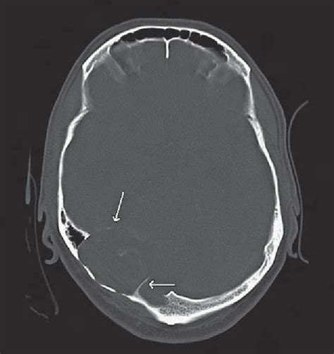 Figure 2 From Giant Intradiploic Epidermoid Cyst Of Occipital Bone