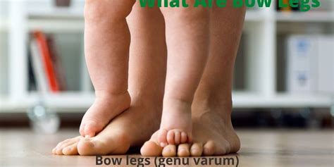 What Are Bow Legs Causes And Symptoms