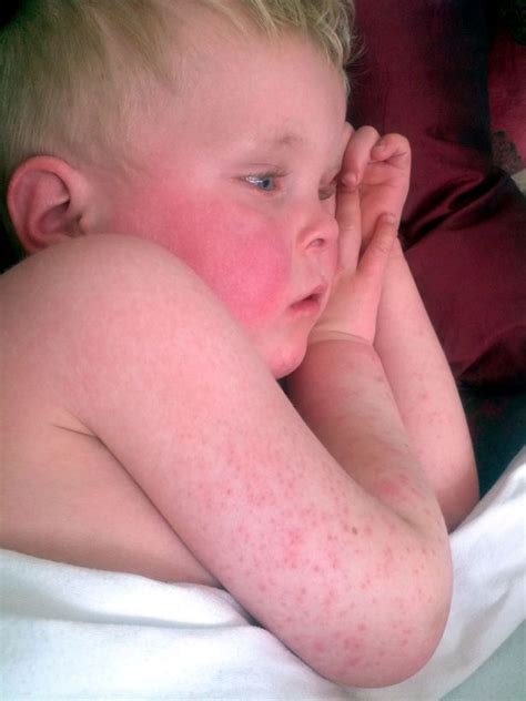Rise In Scarlet Fever Continues Across Devon And The Uk Devon Live